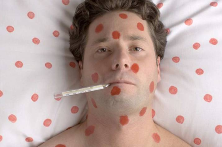 Корь в Луганской области: что нужно знать