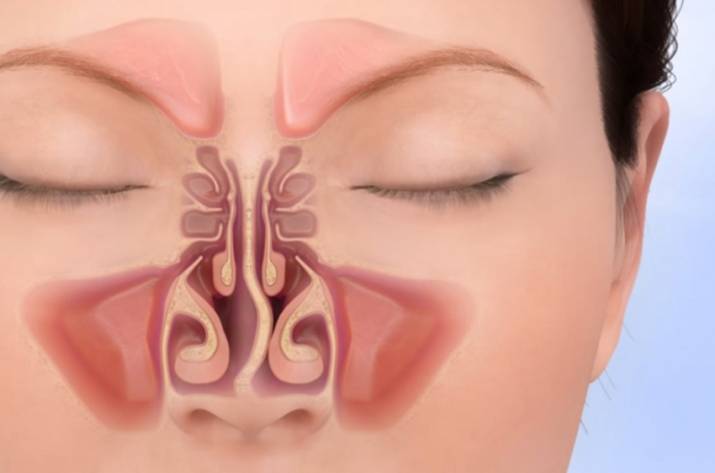 септопластика