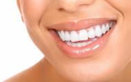 улыбка виниры на зубы