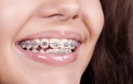 брекеты на зубах